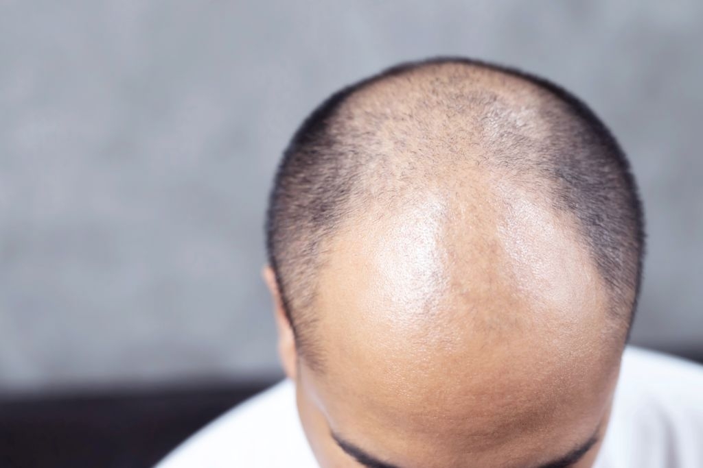 La alopecia