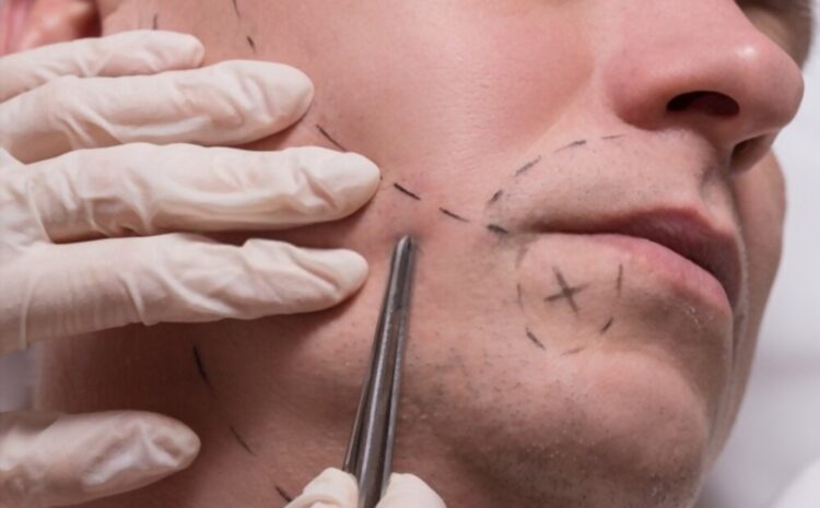  Implante de barba: Beneficios