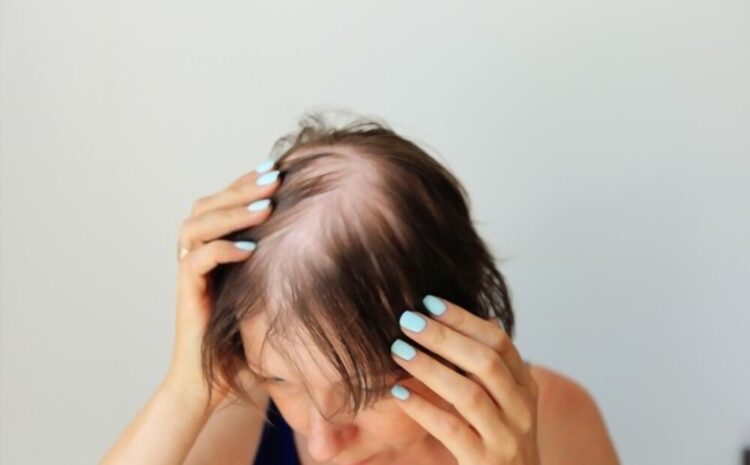  Causas de la alopecia femenina