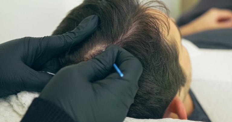 ¿Cuánto dura la micropigmentación capilar? Factores, cuidados y duración real