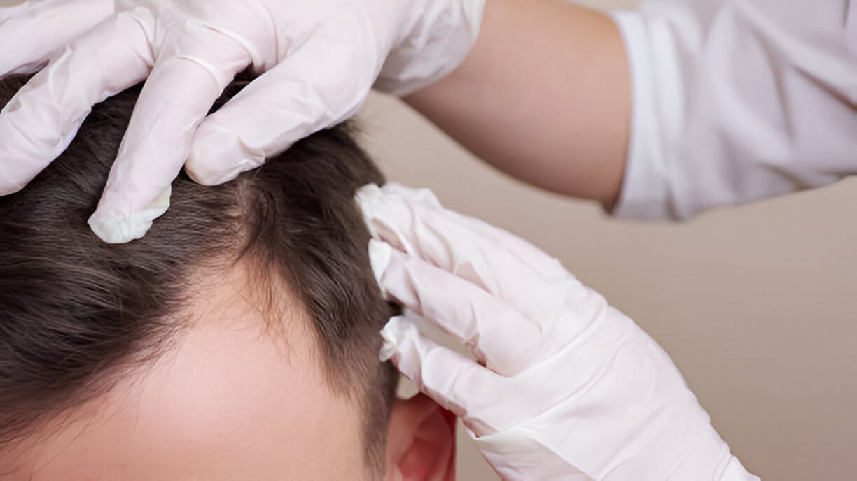Dermatitis Seborreica y la Calvicie: ¿Relación?