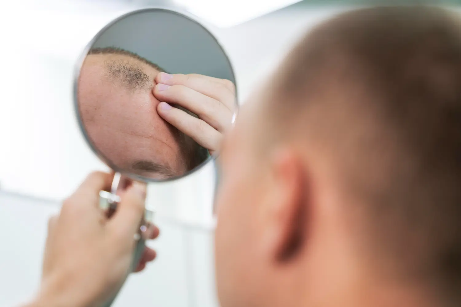 ¿Qué hacer ante una alopecia severa?