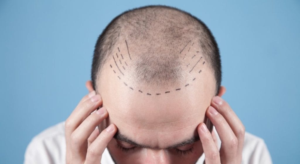 7 errores comunes antes de un injerto capilar